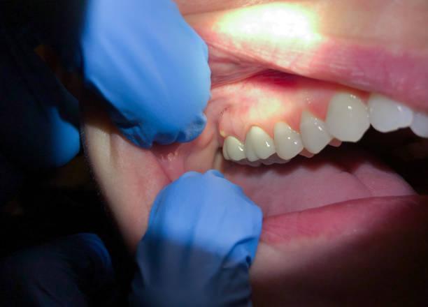 Best Dental Abscess Treatment in Springfield, MI